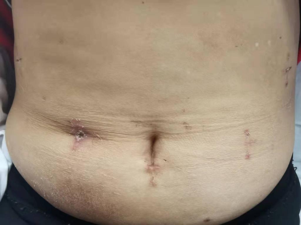 我院胃肠疝外科成功开展陕北首例全腹腔镜下右半结肠癌根治术+NOSES术