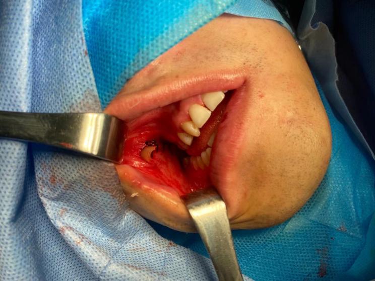 我院口腔颌面外科成功完成一例右侧翼腭窝肿瘤手术